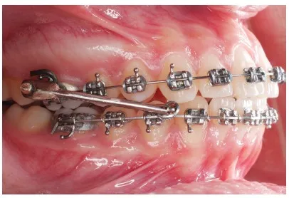 Aparelho de Protração Mandibular instalado em aparelho ortodôntico fixo