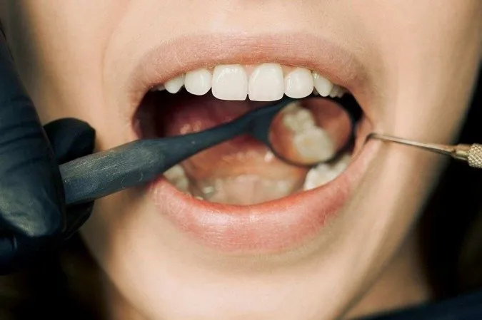 Imagem ilustrativa da reportagem: exame odontológico com espelho bucal.